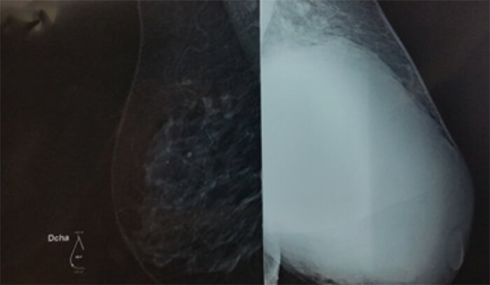 Figura 3. Mamografía de paciente en su proyección mediolateral oblicua.