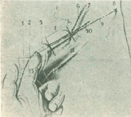 Figure 1. Outline of the incision with its anatomical reference points. 1.- Pubic symphysis 2.- Pubic spine 3.- Superficial orifice of the inguinal canal 4.- Inguinal canal 5.- Deep orifice of the inguinal canal 6.- Left testicular artery 7.- Left testicular vein 8.- Iliac spine anterosuperior 9.- Inguinal arch 10.- Incision layout 11.- Inguinal fold 12.- Obturator foramen 13.- Left index finger inserted into the root of the hemiescrotum, to locate the superficial orifice of the inguinal canal.