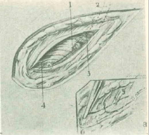 Figure 10. Surgical wound suture by levels. 1.- Left testicular artery 2.- Left testicular vein 3.- Small accessory vein 4.- Muscular wall a.- Synthesis of the aponeurosis 5.- Point for suturing the aponeurosis of the external oblique muscle of the abdomen 6.- Point for protection of the inguinal canal.