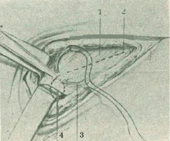 Figure 2. Section of the aponeurosis of the external oblique muscle of the abdomen with the inguinal protection point of
A. Grimaldi. 1- Aponeurosis of the external oblique muscle of the abdomen 2.- Layout of the aponeurotic section. 3.- Protection point of the inguinal canal 4.- Deep opening of the inguinal canal below and in front of the previous point.