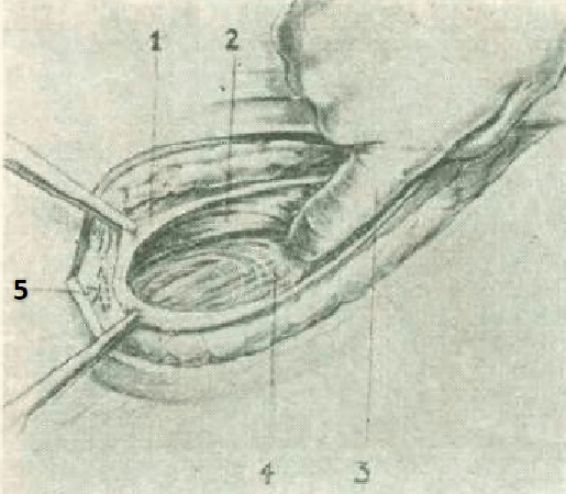 Figure 3. Identification of the deep orifice of the inguinal canal and traction of the deep orifice of the inguinal canal 1.- Aponeurosis of the external oblique muscle of the opened abdomen 2.- Fibers of the internal oblique and transverse abdominal muscles that constitute the deep orifice of the inguinal canal, raised by the index finger of the right hand 3.-hooked right index finger pulling upward the deep orifice of the inguinal canal to expose the vascular elements of the left testicle 4.- Vascular elements of the left testicle covered by the cremaster muscle 5.- A. Grimaldi’s protection point.