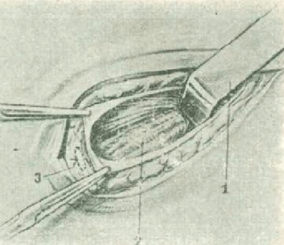 Figure 4. Once the deep orifice of the inguinal canal is recognized, the Farabeuf separator replaces the index finger for traction of the deep orifice of the inguinal canal and the vascular elements of the left testicle covered by the cremaster are identified. 1.- Farabeuf separator 2.- Cremaster muscle covering the vascular elements of the left testicle 3.- Protection point.