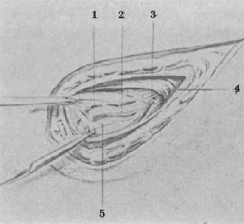 Figure 5. Traction of the internal spermatic fascia downwards and inwards with two Crile forceps (“first traction maneuver”). 1.- Left testicular artery intimately adhered to the most anterior left testicular vein, covered by the internal spermatic fascia and the abdominal vascular fascia. 2.- Left testicular vein 3.- Muscular fibers of the cremaster separated without sectioning 4.- Deep orifice of the inguinal canal. 5.- Internal spermatic fascia pulled and lifted by 2 Crile forceps.