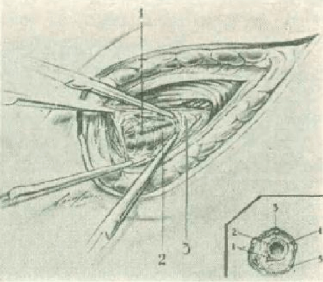 Figure 6. Section the internal spermatic fascia (transversalis fascia), showing the vascular elements of the left testicle covered by the abdominal vascular fascia. Traction of the vascular fascia downwards and inwards with two Crile forceps (“second traction maneuver”). 1.- Left testicular artery 2.- Left testicular vein 3.- Vascular fascia pulled downwards and inward (“2nd traction maneuver”). a) Schematic cross section of the spermatic cord at the level of the deep ring of the inguinal canal showing the relations between the vessels and covers: 1.- Left testicular artery below and inside the left testicular vein 2.- Left testicular vein 3. - Vascular fascia of the abdomen or perivenous fascia 4.- Internal spermatic fascia 5.- Cremaster muscle.