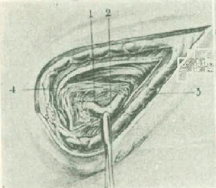 Figure 7. Section of the vascular fascia, exposing the left testicular vein and artery. The testicular artery is recognized as being located below and inside the testicular vein. The vascular fascia of the abdomen, the only level of existing cleavage to be able to isolate the artery. 1.- Left testicular artery 2.- Left testicular vein 3.- Vascular fascia of the abdomen 4.- Internal spermatic fascia.