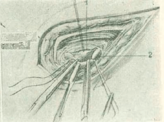 Figure 8. Ligation and section of the testicular vein. The left testicular artery recognized and separated from the left testicular vein by a strand of thread, to avoid its injury and inclusion in any ligature. 1.- Left testicular artery 2.- Left testicular vein.