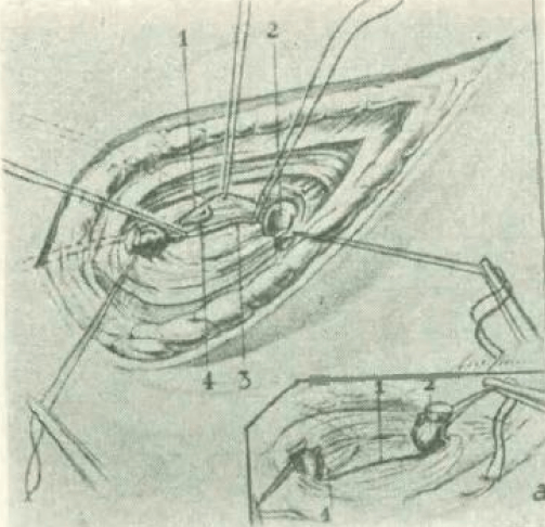 Figure 9. Search other predeferential veins (3) that may exist. Ligation of a small accessory vein. 1.- Left testicular artery 2.- Left testicular vein 3.- Small accessory vein 4.- Elbow of the vas deferens a.- Outline showing the double venous ligation and the left testicular artery forming a bridge between the ends of the left testicular vein.